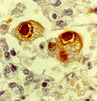 Durch die Cytomegalovirus-Infektion veränderte Zellen (sogenannte Eulenaugenzellen) im Gewebsverband.